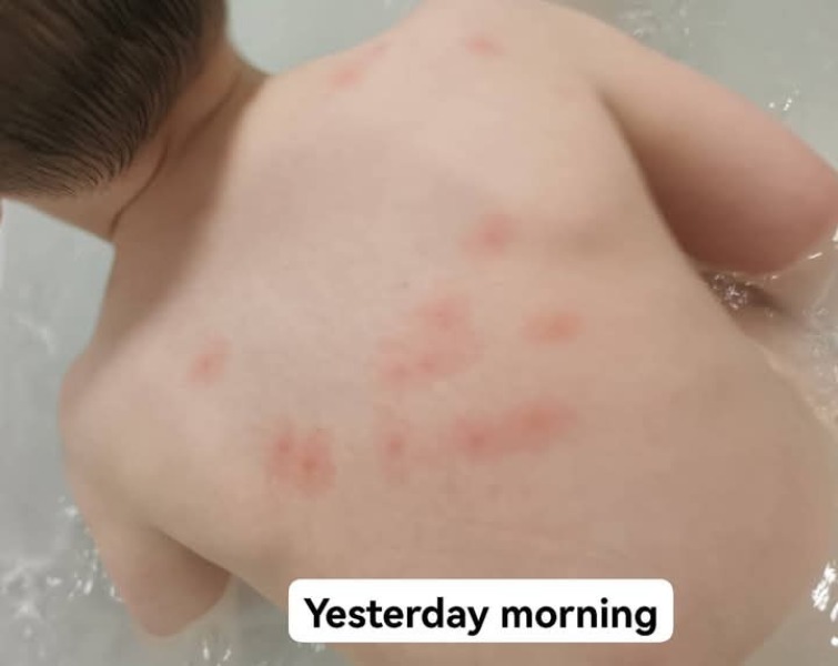 Chicken pox?
