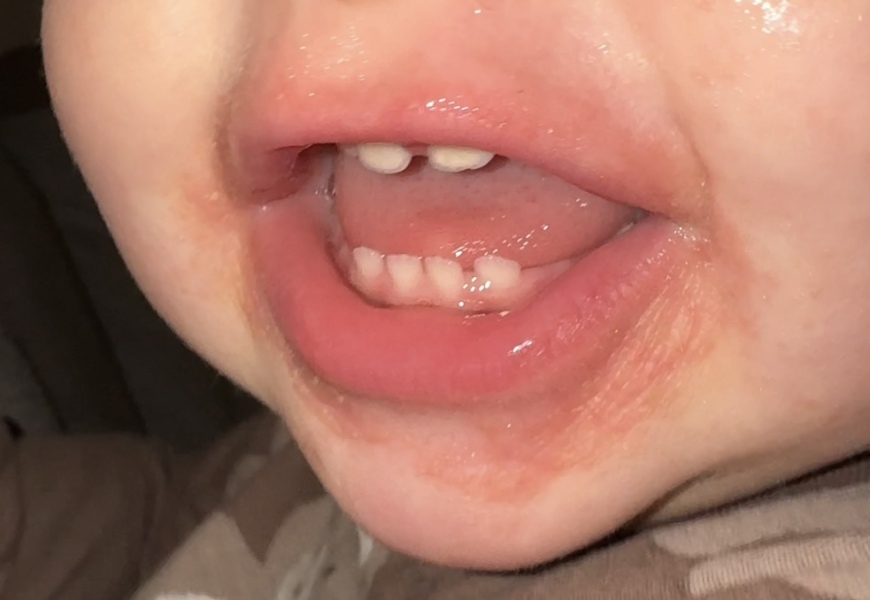 Help! 18mo DS has persistent rash around mouth