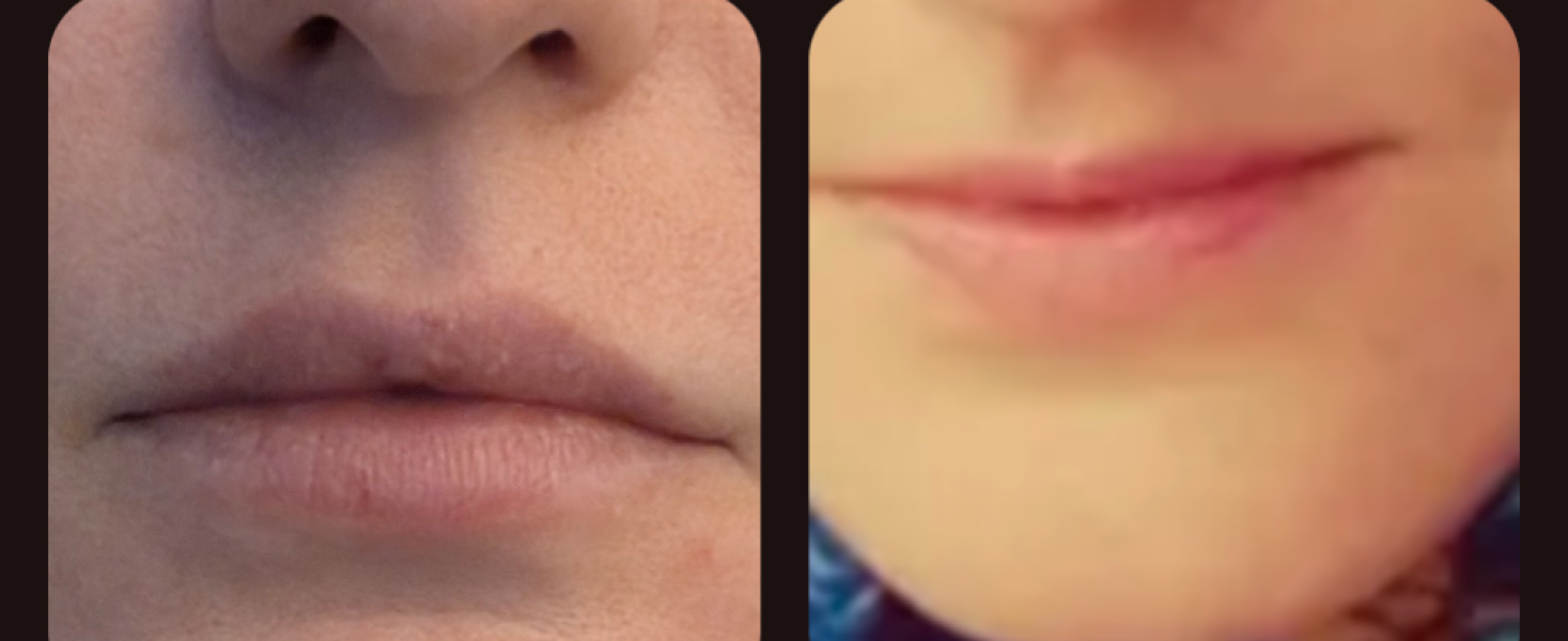 Why do people get massive amounts of lip filler?