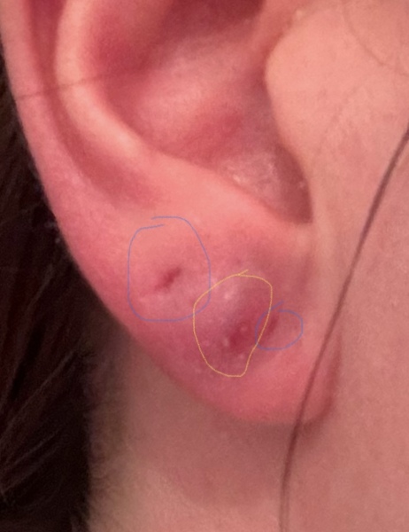 What is this on my ear? GP doesn’t know?