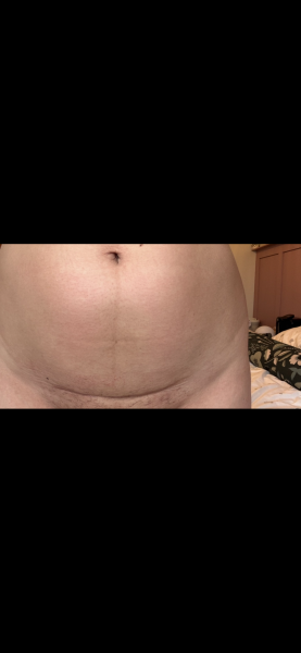 Second C Section Recovery