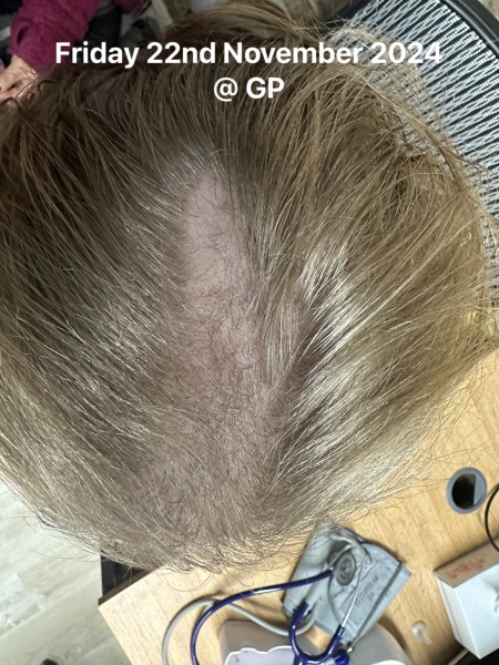 Hair Loss in an 11 year old