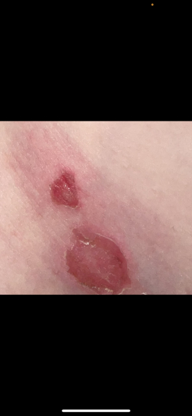 Sores on 5 year old
