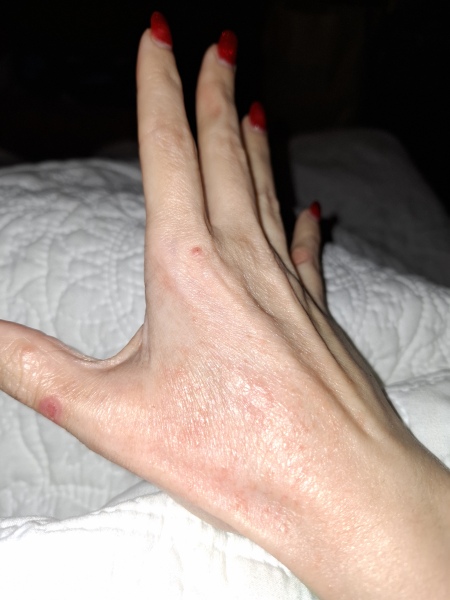Hand infected (Warning, gross photos)