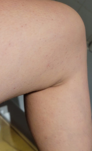 What's this rash?