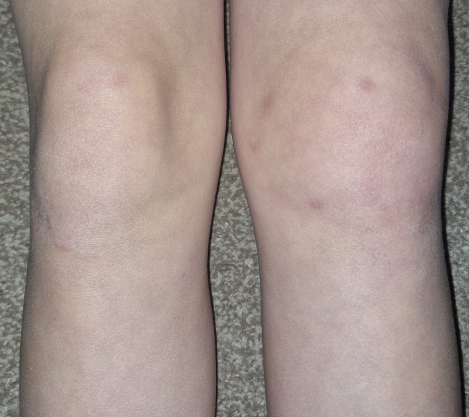 Swollen knee in child