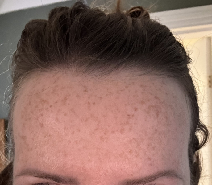 Tretinoin 0.006 - I think I can see an improvement already!! (Pic)
