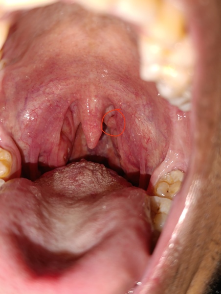 Red bump in back of throat