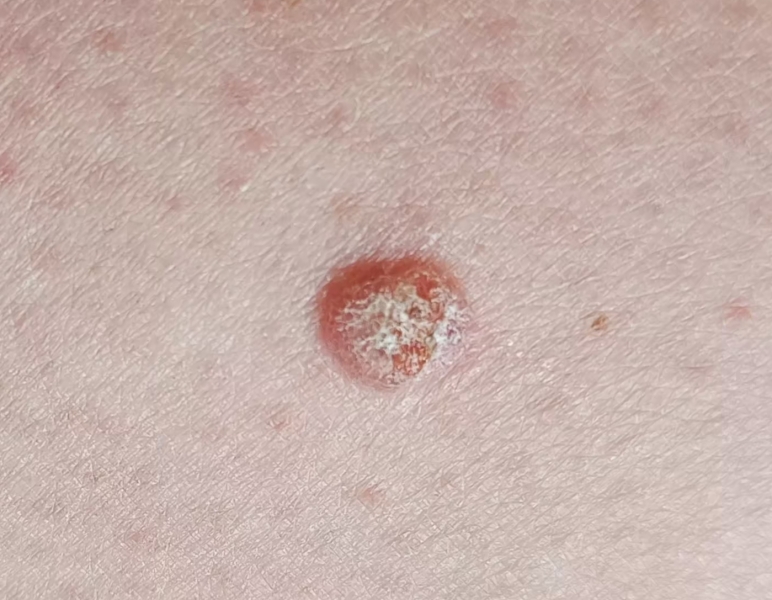 Crusty lump on leg