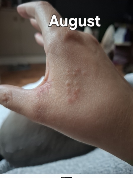 Hand infected (Warning, gross photos)