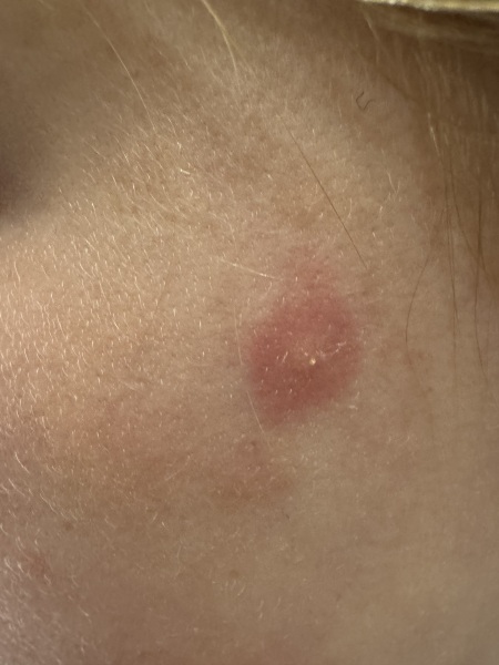 What is this!? Spot on face