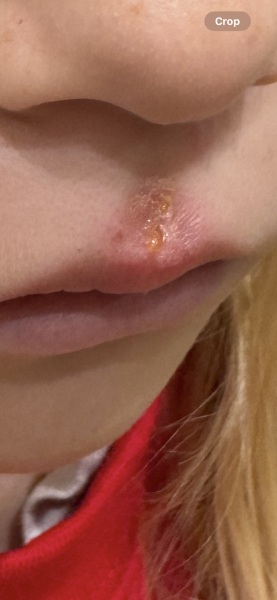 Cold sore and whitlow finger?!