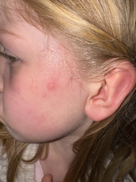 What is this!? Spot on face