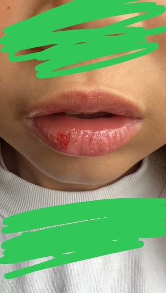 Cold sore or chapped lips?
