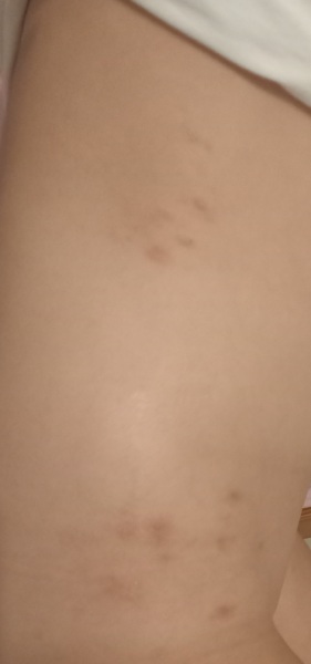 Skin rash