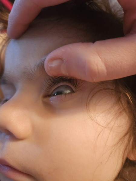 Can anyone put my worried mind at ease? What are these dark spots in my toddler’s eye?