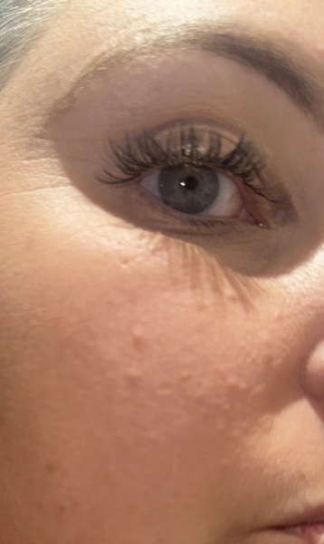 Face bumps? With pics!