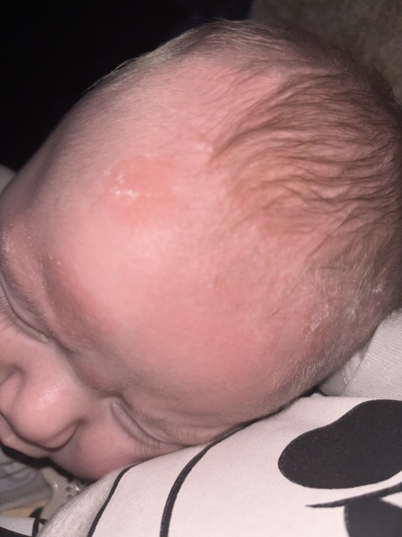 What is this on my sons head???