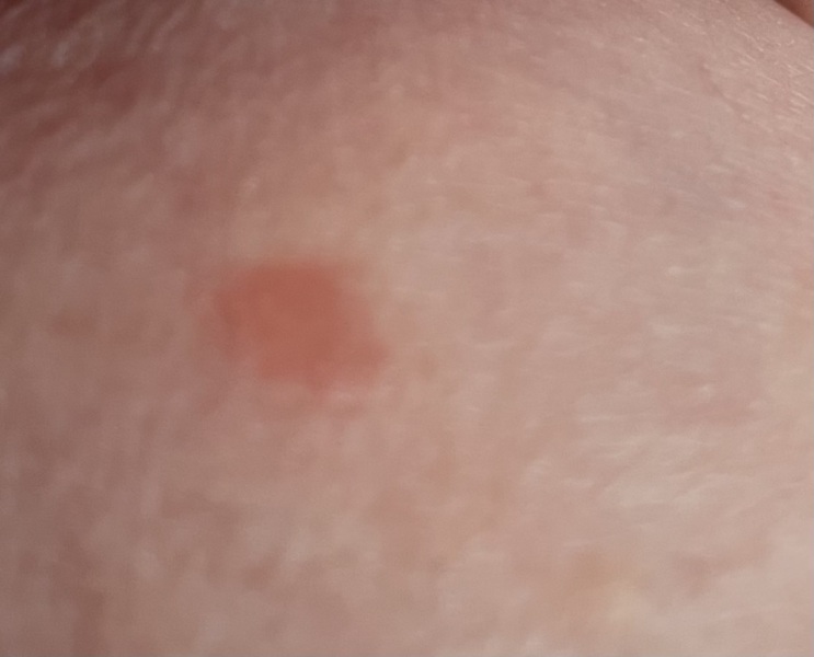 Spot on breast - not sure if I should be concerned?