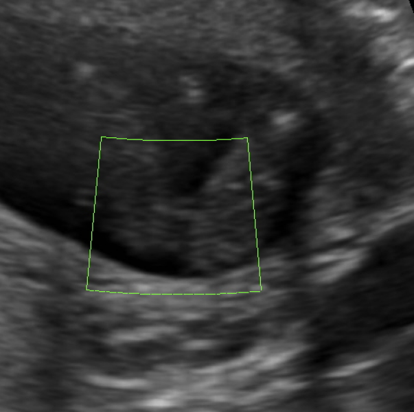 16 Week ultrasound - Boy or Girl?