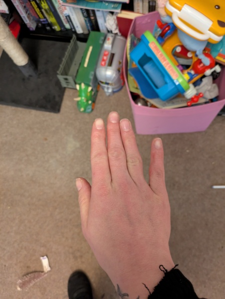Have I dislocated my finger?! (Photo warning)
