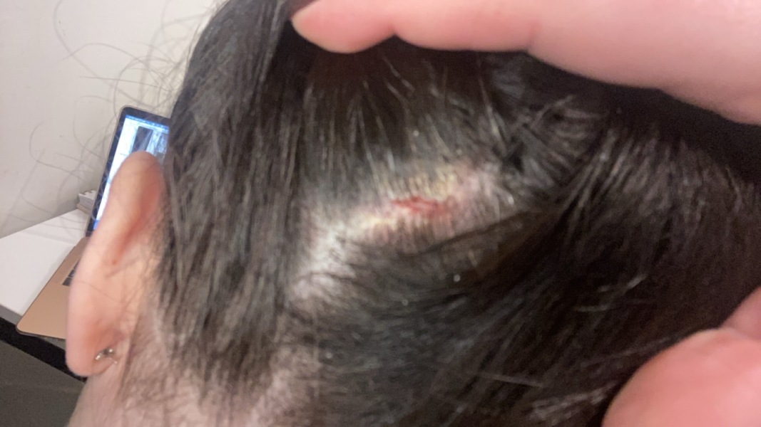 Open sores on scalp