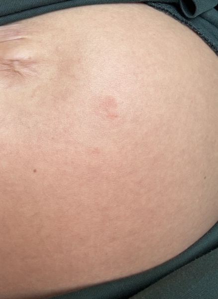 Is this the start of stretch marks?? :(