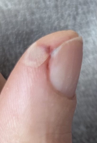 Cut thumb