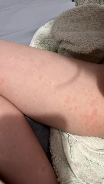 Dd aged for in hospital with quinsy tonsillitis last week, now has hives - what to do?
