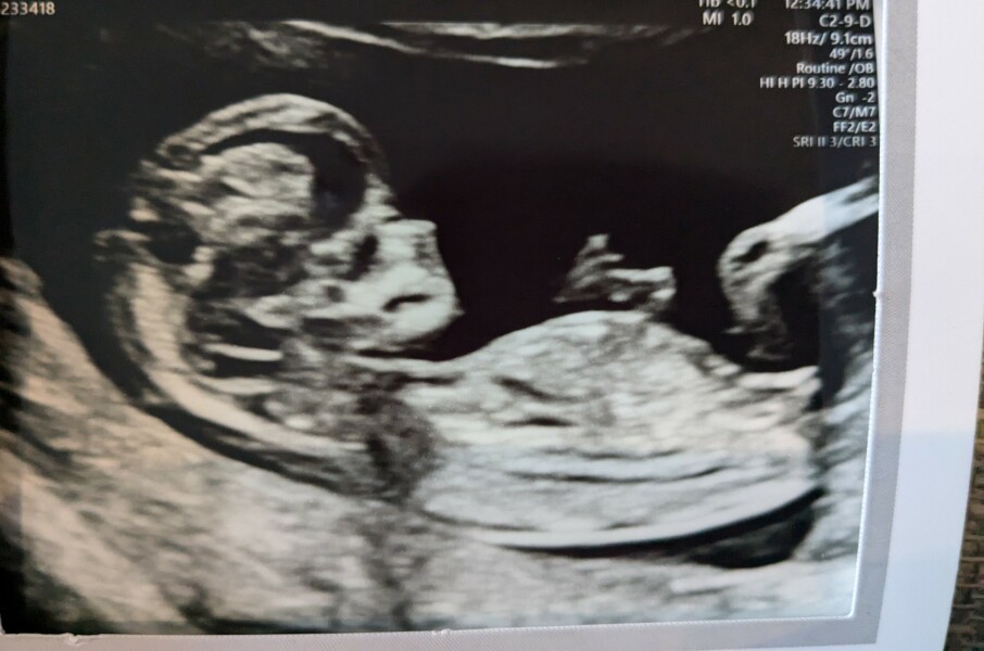 Due July 25 - Thread 2 - Approaching the 12 week scans!