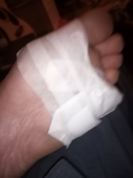 Melanoma on little toe? Picture attached.