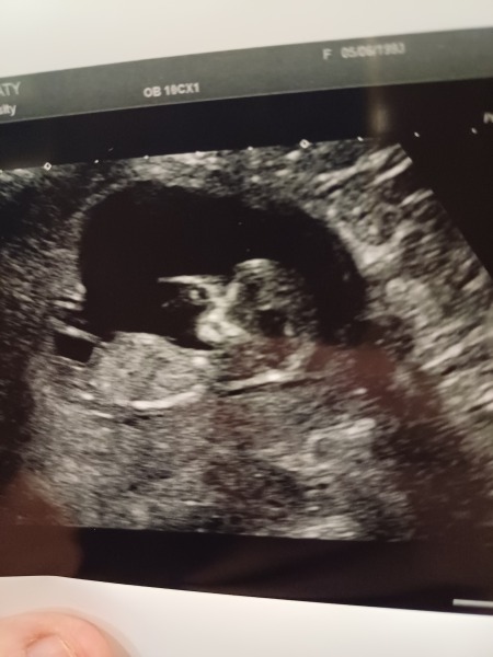 12 week scan boy or girl