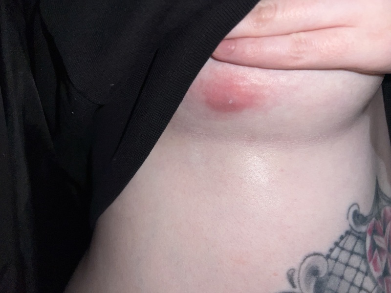 Lump in breast
