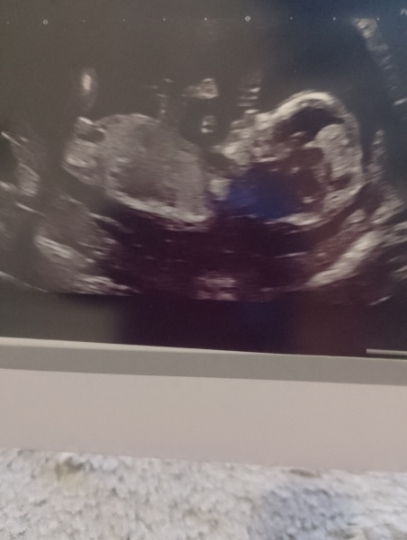 13 weeks nub