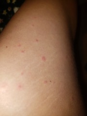 Christmas rash