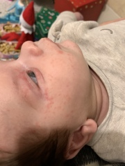 Baby acne/eczema or CMPA rash? Help pls.