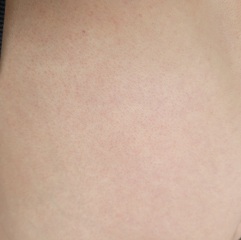 Rash and nausea