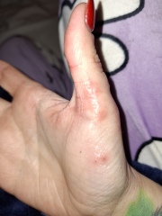 Hand infected (Warning, gross photos)