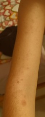 Skin rash