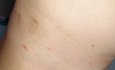 Skin rash