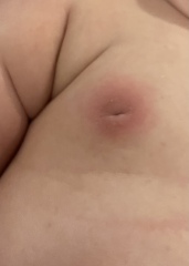 6 month old boy red, swollen nipple with bump