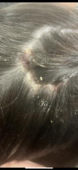 Open sores on scalp