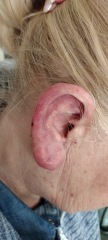 ENT / swollen ear / can’t get a diagnosis :-/