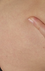 Rash and nausea
