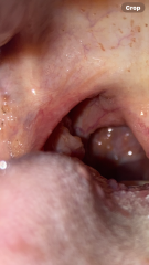Tonsil Cancer? Any experience or knowledge? *PICTURE*