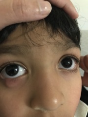 Chalazion 4 year old