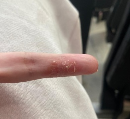 Is this Excema or something else, with photos.