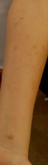 Skin rash