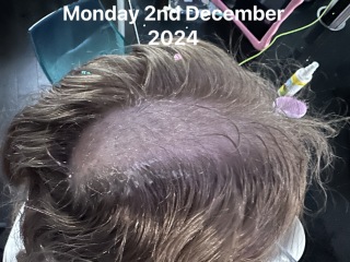 Hair Loss in an 11 year old