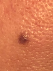 Anyone medical about? Family here for Christmas worried about a new bump on my face (photo)